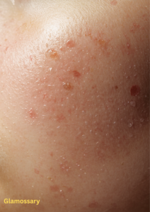 visible enlarged pores on cheeks with softly blended blush for smoother appearance