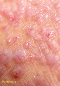 eczema prone skin on cheeks with gentle blush application using cream blush