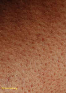 visible enlarged pores on cheeks with softly blended blush for smoother appearance