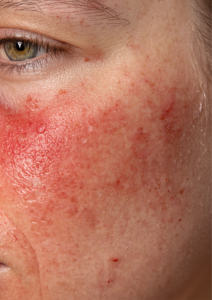 rosacea redness on cheeks with natural blush application using soft neutral tones