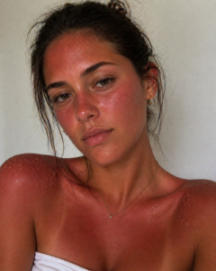Woman with visible sunburn on face, shoulders, and chest showing red, irritated skin in natural light