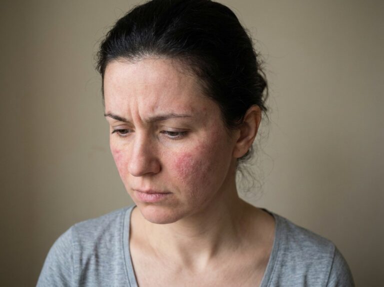 Woman with red, irritated skin and dry patches on her face